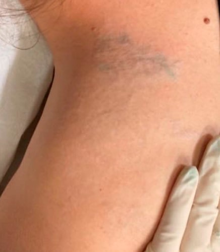 REMOÇÃO_TATUAGEM_DEPOIS